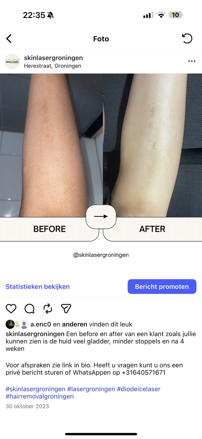 Before en after resultaat