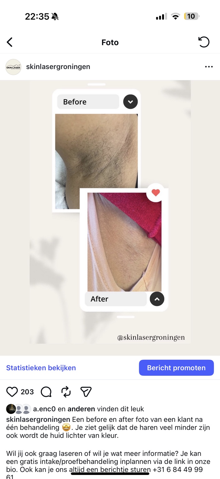 Before en after resultaat