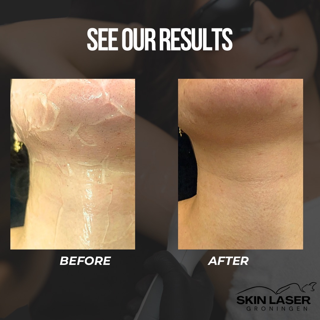 Before en after resultaat
