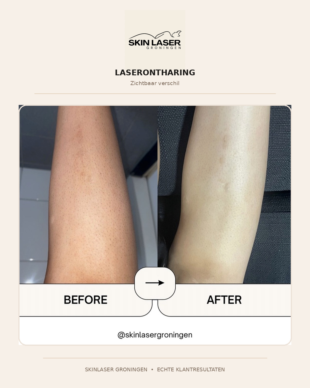 Before en after resultaat